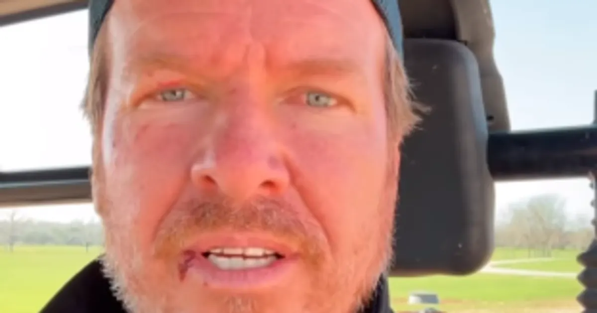 'Fixer Upper' Chip Gaines Has Facial Injuries What Happened?