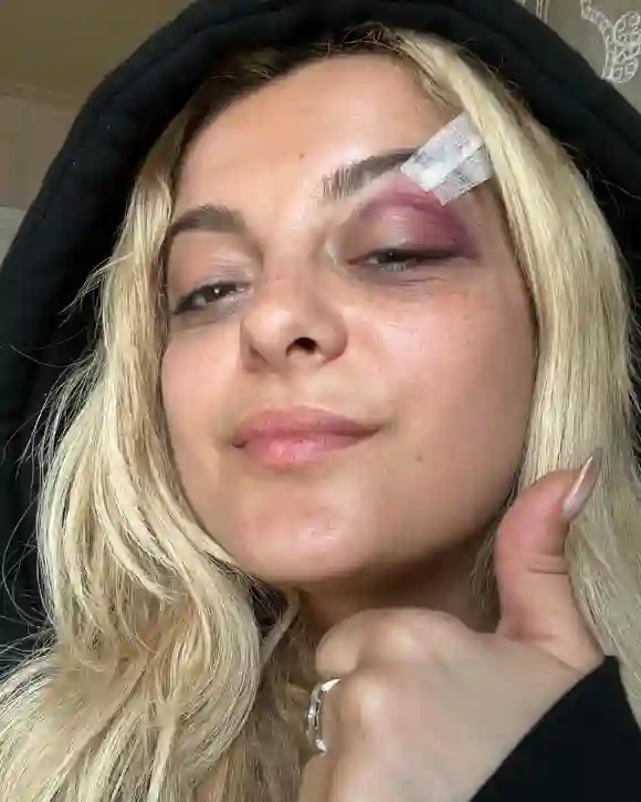 Bebe Rexha after cell phone attack